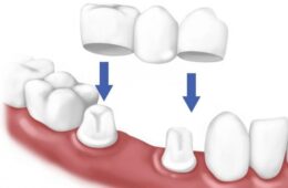 Cầu răng sứ Zirconia là gì