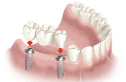 Cầu răng sứ Zirconia có tốt không